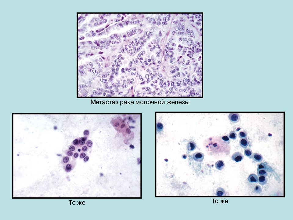 Цитологическая диагностика заболеваний молочной железы презентация