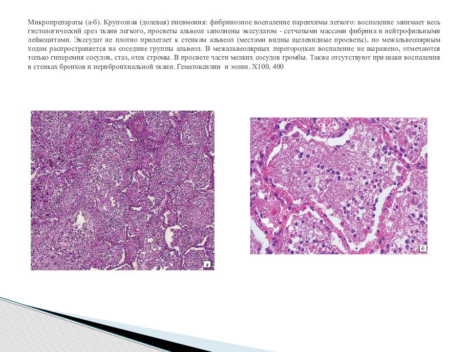 Пневмония микропрепарат описание. Фибринозный перикардит гистология. Абсцедирующая пневмония гистология. Фибринозное воспаление патанатомия. Фибринозная пневмония гистология.