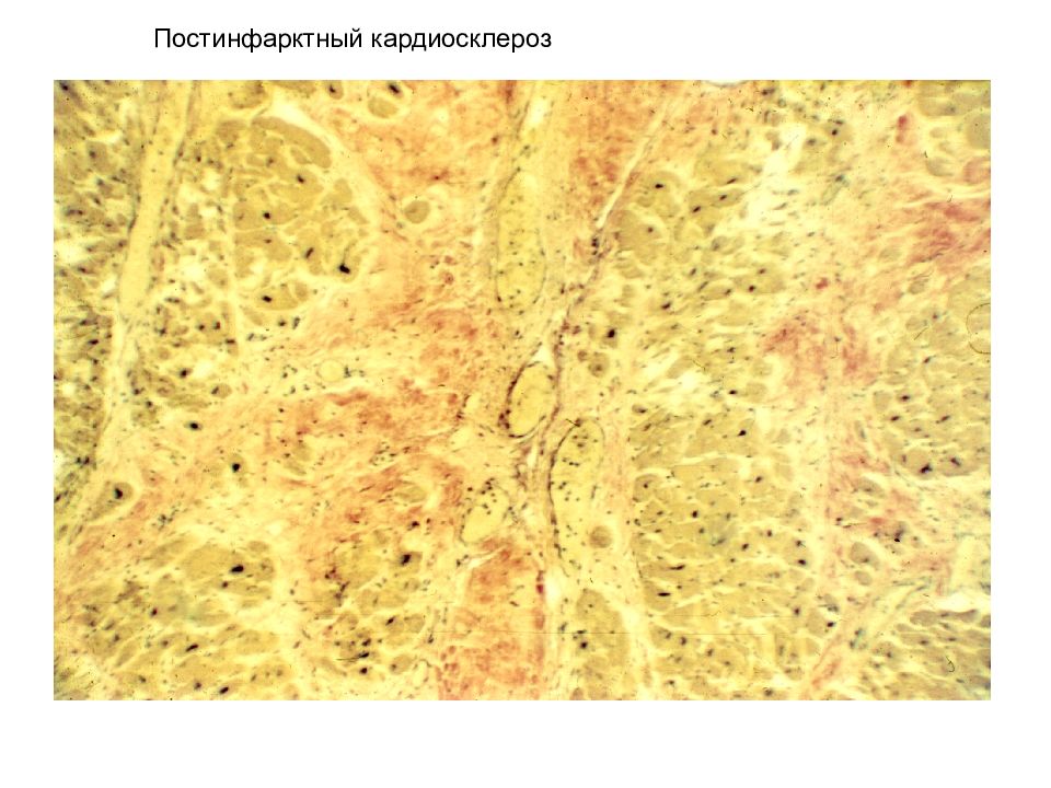 Кардиосклероз что это такое простыми словами. Постинфарктный кардиосклероз препарат патанатомия. Постинфарктный кардиосклероз гистология. Диффузный кардиосклероз. Атеросклеротический кардиосклероз микропрепарат.