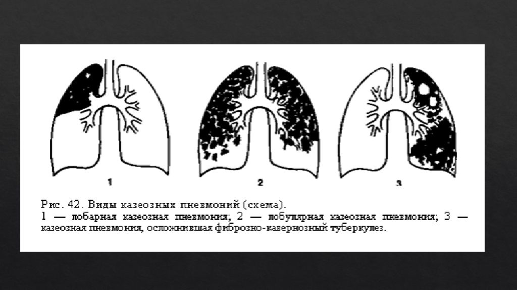 Пневмония виды. Казеозная пневмония кт картина. Казеозная пневмония МСКТ. Казеозная пневмония на кт легких. Острая пневмония средней доли схема.