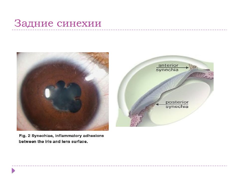 Синехии у девочек. Синехия офтальмология.