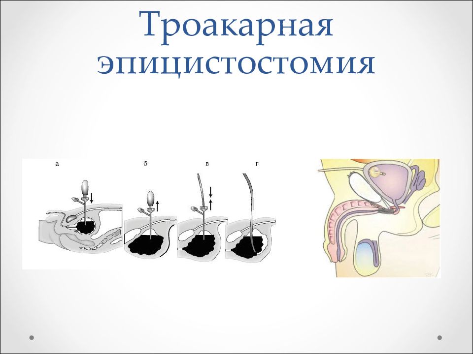 Эпицистостома. Троакарная цистостомия техника операции. Эпицистостомия Оперативная хирургия. Троакарная эпицистостомия этапы. Эпицистостомия мочевого пузыря техника.