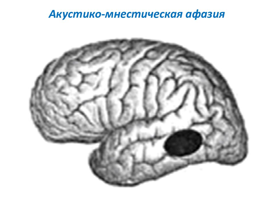 Акустико мнестическая афазия картинки