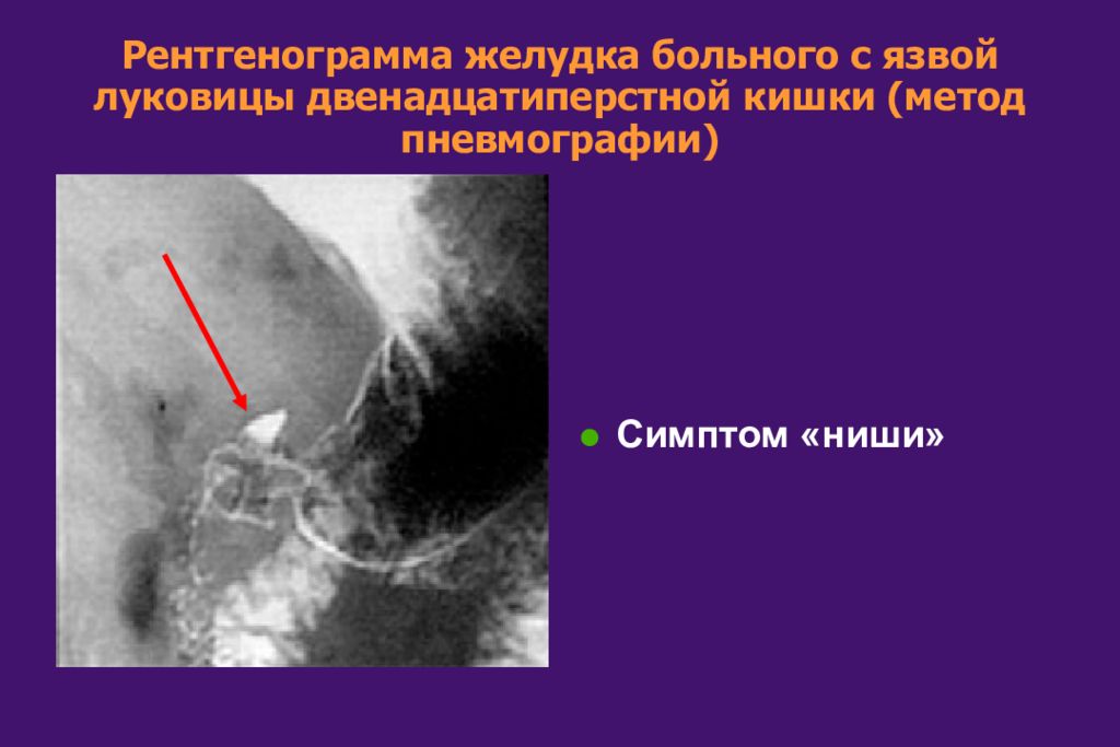 Язв болезнь 12 перстной кишки. Перфоративная язва ДПК. Рентген язвы желудка симптом ниши. Язва луковицы ДПК рентген.