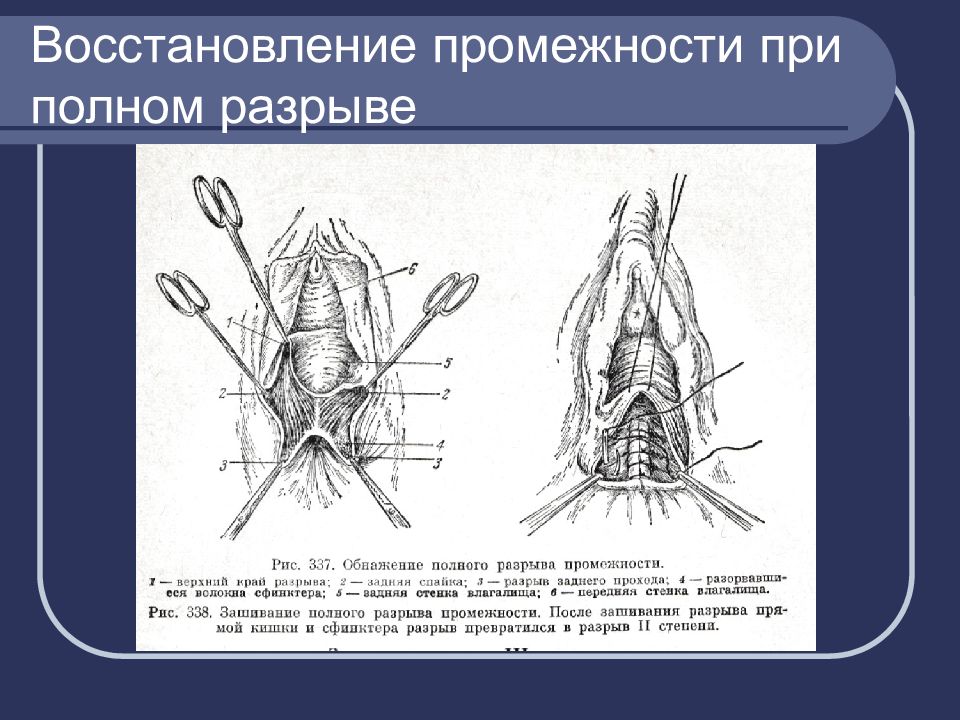 Акушерский травматизм презентация