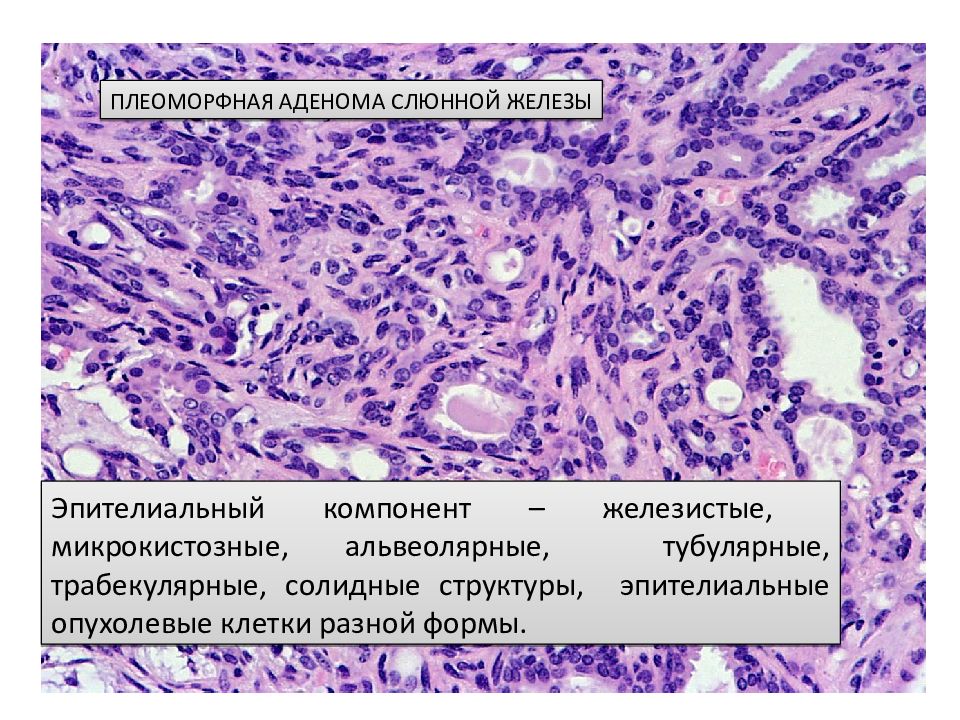 Доброкачественные и злокачественные опухоли слюнных желез презентация