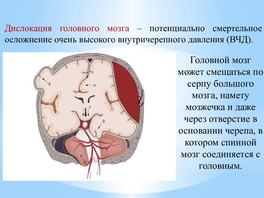 Дислокация мозгах