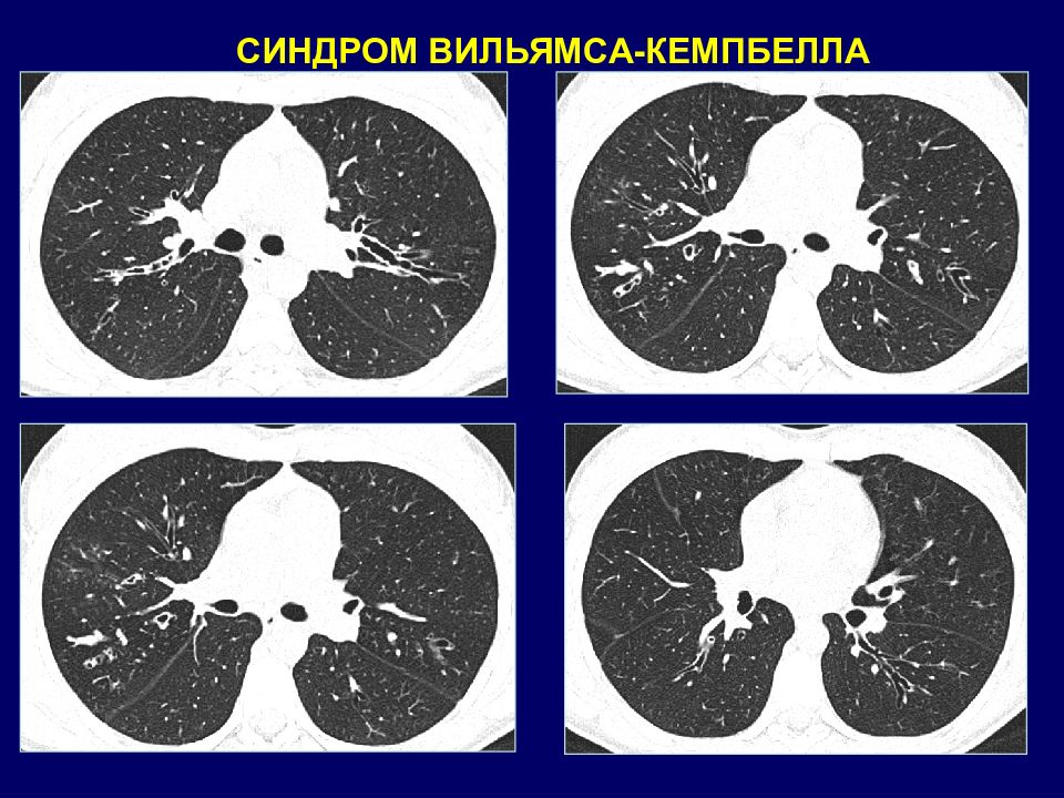 Лучевая диагностика хобл презентация