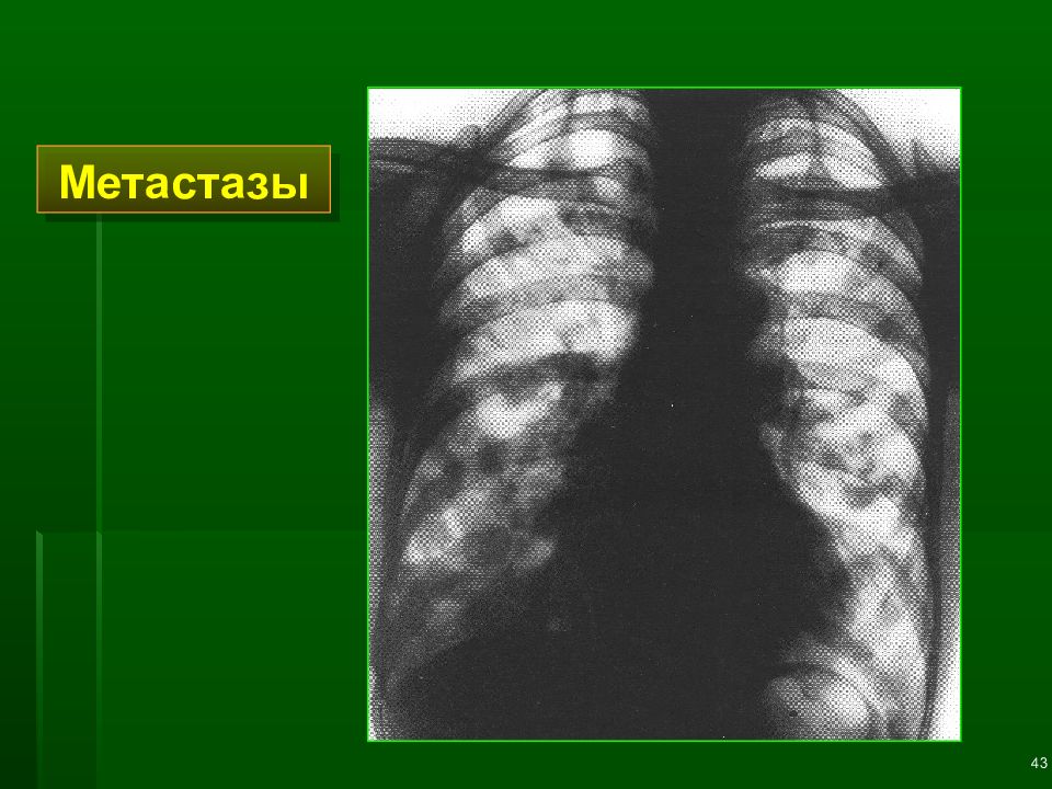 Пошли метастазы в легкие. Лучевая диагностика легких презентация. Симптомы патологии легких лучевая диагностика. Метастазы в лёгких симптомы.