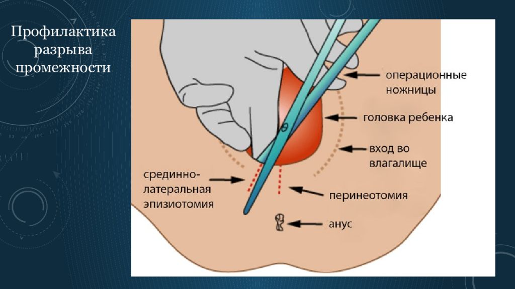 Перинеотомия и эпизиотомия презентация