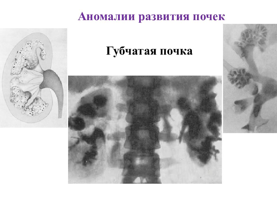 Губчатая почка фото