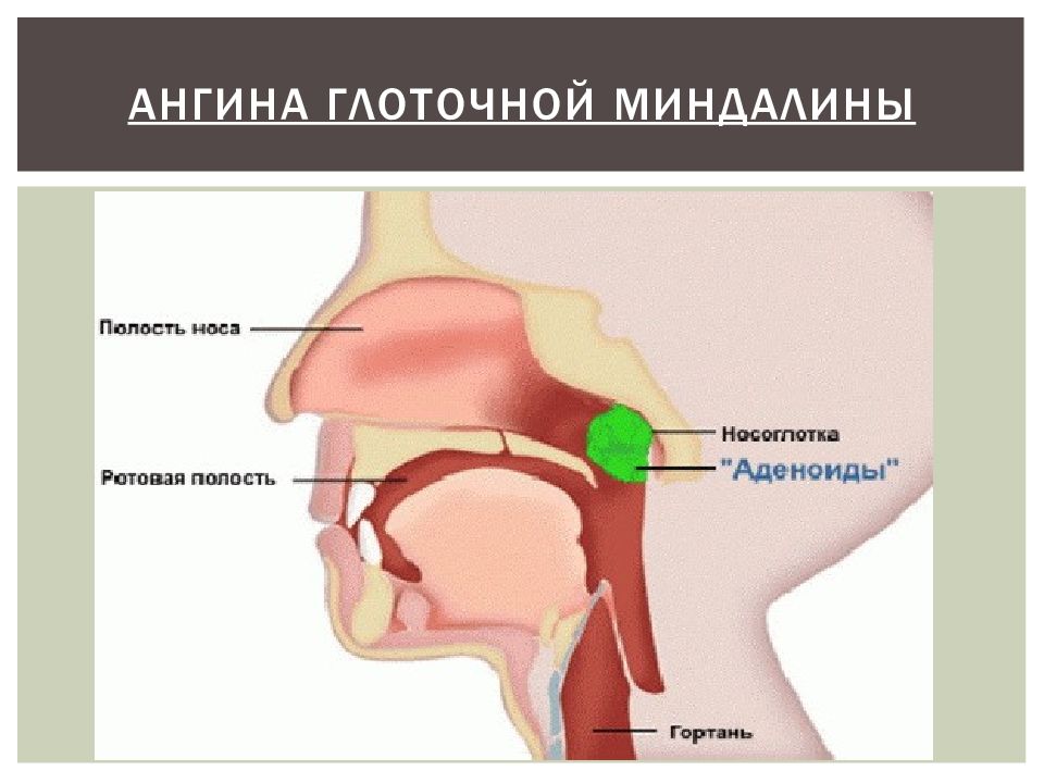 Задняя стенка носоглотки. Ангина глоточной миндалины. Глоточная миндалина латынь. 452. Глоточная миндалина.