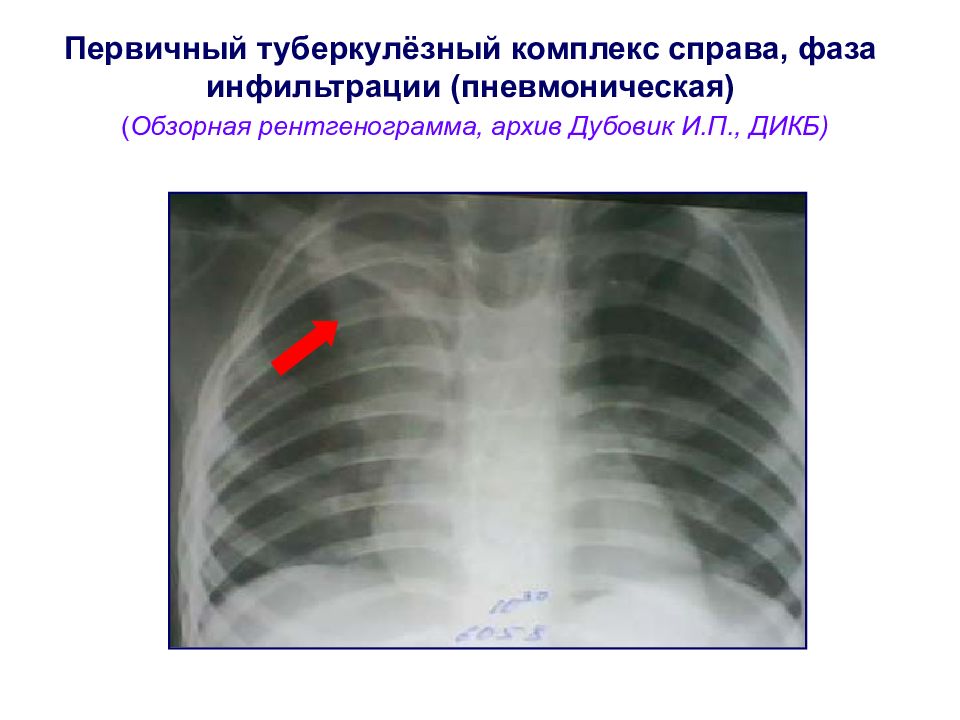 Гон легких. Первичный туберкулезный комплекс в фазе инфильтрации рентгенограмма. Первичный туберкулезный комплекс фаза биполярности рентген. Первичный туберкулезный комплекс фтизиатрия. Пневмоническая стадия первичного туберкулезного комплекса.