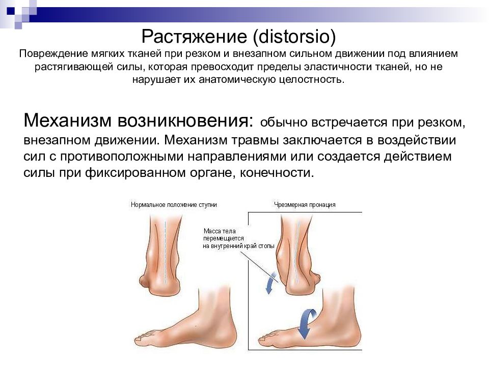 Ушибы растяжения вывихи симптомы. Классификация травма голеностопного сустава растяжение связок. Вывих растяжение стопы.