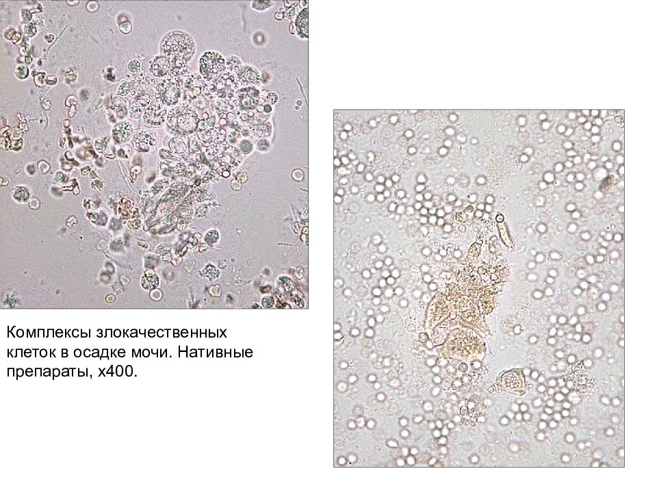 Микроскопия осадка. Микроскопия нативного препарата мочи. Микроскопия +нативного осадка мочи. Микроскопия осадка мочи презентация. Микроскопия осадка мочи фото с описанием.