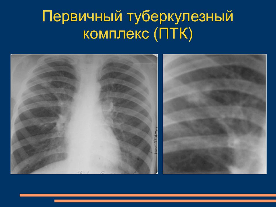 Туберкулезный комплекс. Первичный туберкулезный комплекс очаг гона. Первичный туберкулезный комплекс у детей рентген. Первичный туберкулез рентген. Первичный туберкулезный комплекс на рентгенограмме.