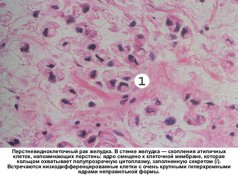 Рак желудка патанатомия презентация