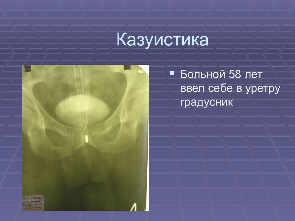 Казуистика. Казуистика это простыми словами в медицине. Казуистика что это такое словами в медицине. Градусник в уретре фото. Градусник в уретре члена.