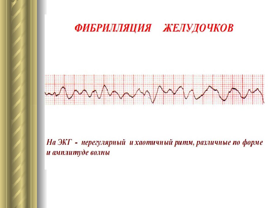 Фибрилляция желудочков на экг картинки