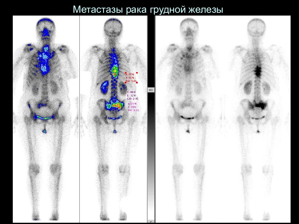 Рак Метастазы Картинки