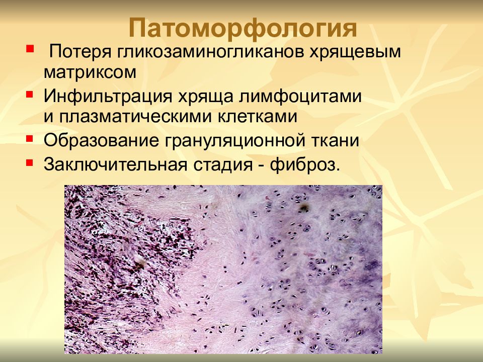 Диффузная представители. Системная склеродермия патоморфология. Диффузные заболевания соединительной ткани. Инфильтрация соединительной ткани.