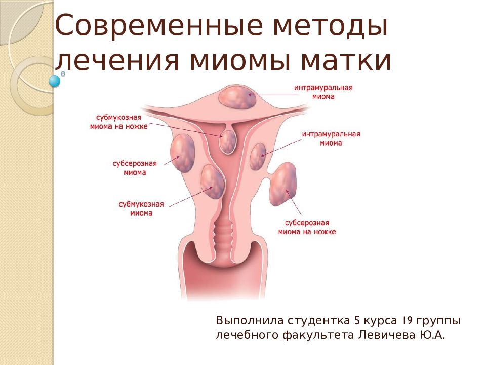 Признаки миомы матки. Презентация на тему миома матки. Современные методы лечения миомы матки.