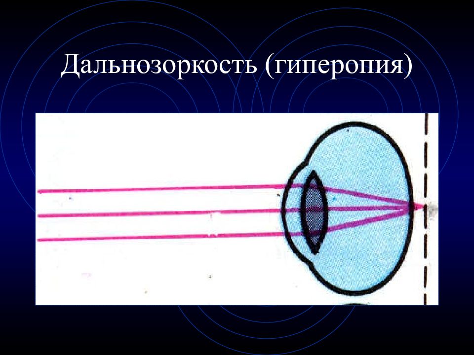 Анализатор зрительный слуховой вестибулярный. Гиперопия.