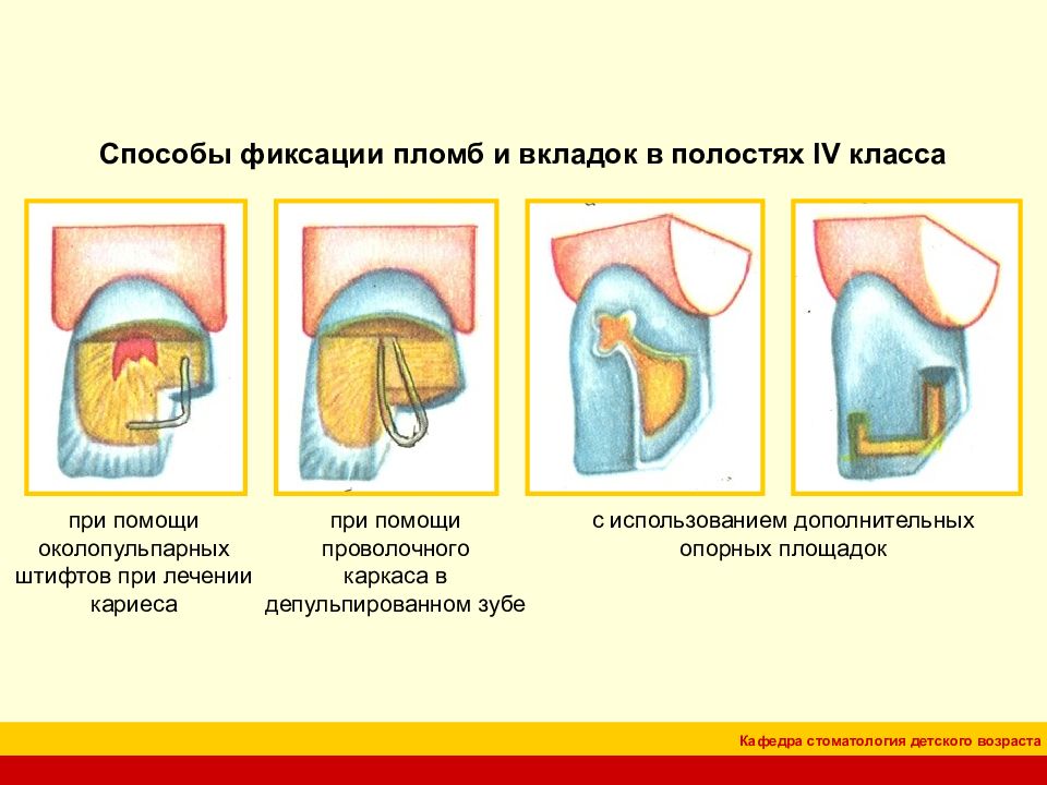 Классы по блэку в стоматологии в картинках