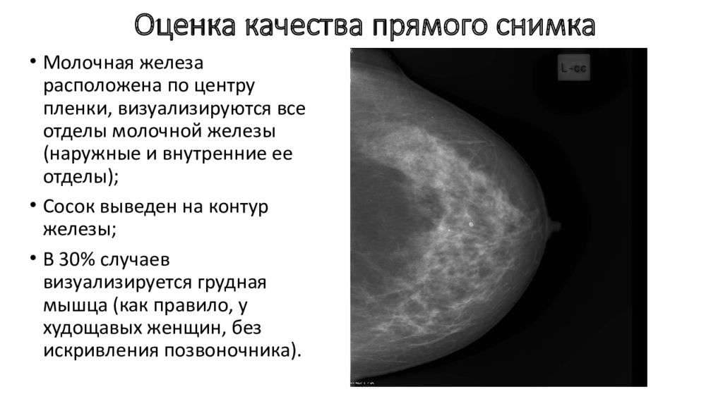 Маммография ответы. Маммография. Маммография молочных желез. Маммография картинки. Добавочная долька молочной железы на маммографии.
