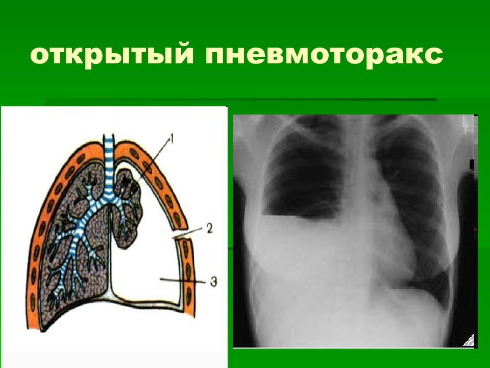 Пневмоторакс картинки для презентации