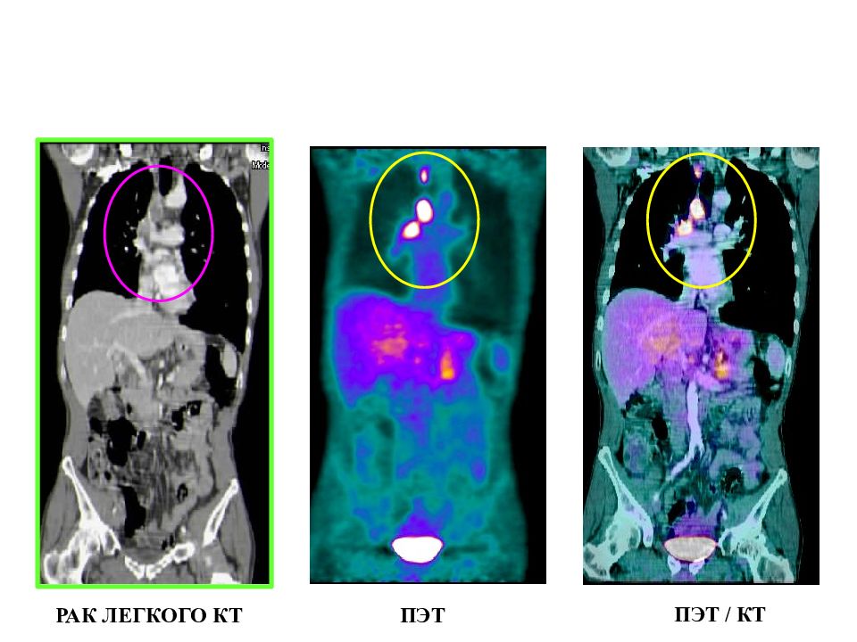 Пэт кт что это при онкологии