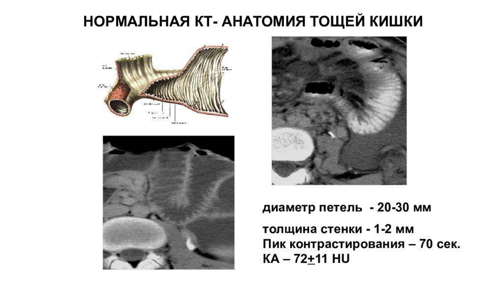 Толщина стенки кишки