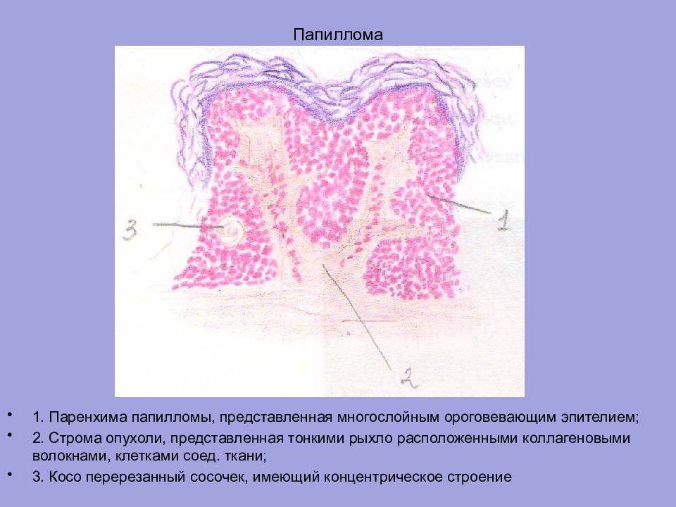 Строение опухоли картинка