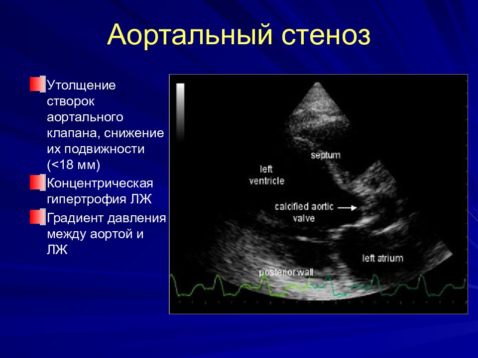 Аорта створки аортального клапана уплотнены. Стеноз аортального клапана ЭХОКГ. Стеноз устья аорты ЭХОКГ. Стеноз устья аорты УЗИ.