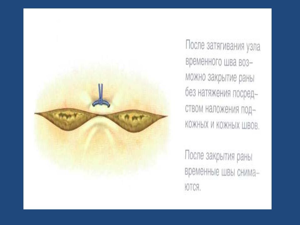 Временный шов