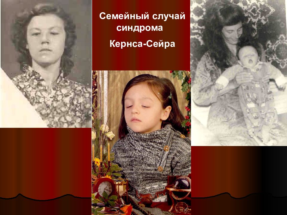 Случай семьи. Синдром Кирнса–Сейра фото. Генетические заболевания с синдромом аутизм.