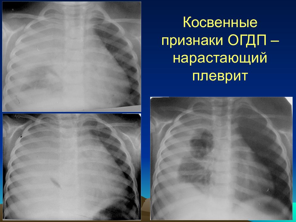 Деструктивная пневмония у детей презентация