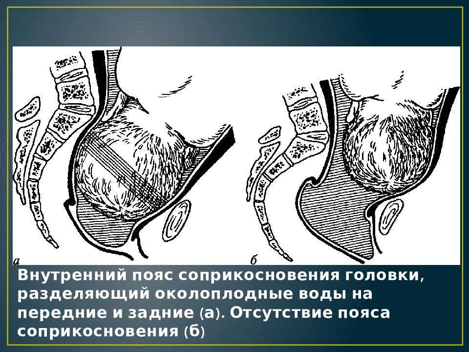 Контракционное кольцо в акушерстве. Наружный пояс соприкосновения. Внутренний пояс соприкосновения. Пояс соприкосновения в акушерстве. Пояс прилегания это в акушерстве.