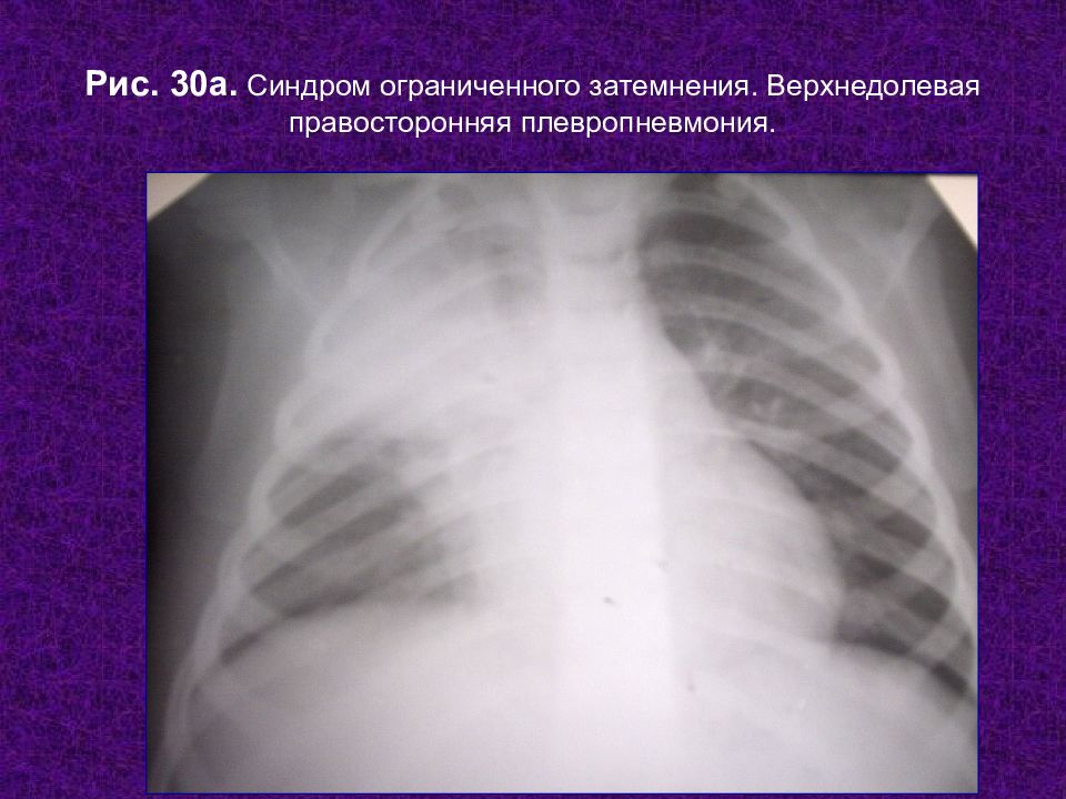 Верхнедолевая пневмония. Синдром плевропневмонии. Правосторонняя плевропневмония. Плевропневмония на рентгенограмме. Синдром ограниченного затемнения.