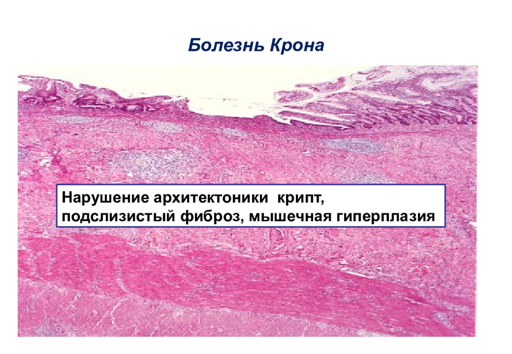 Болезни мышечной ткани