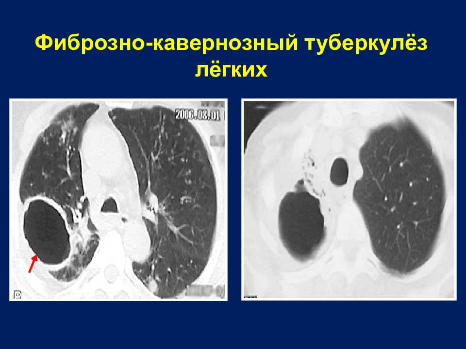 Фиброзно кавернозный туберкулез. Фиброзно-кавернозный туберкулез кт. Инфильтративно кавернозный туберкулез кт. Фиброзно-кавернозный туберкулез легких кт.