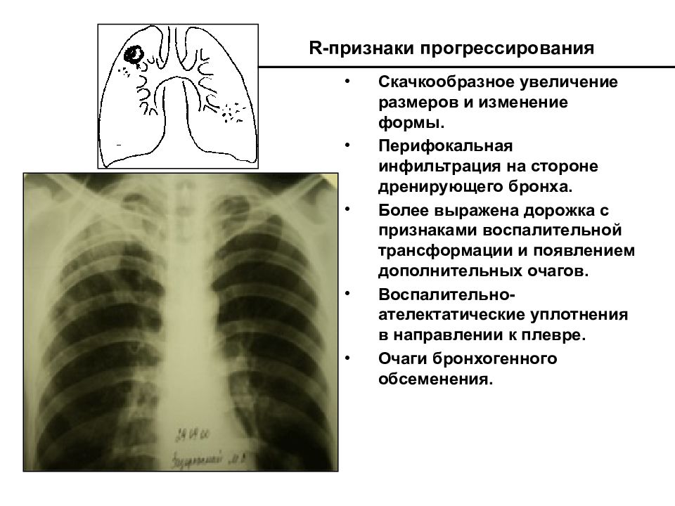 Презентация очаговый туберкулез легких