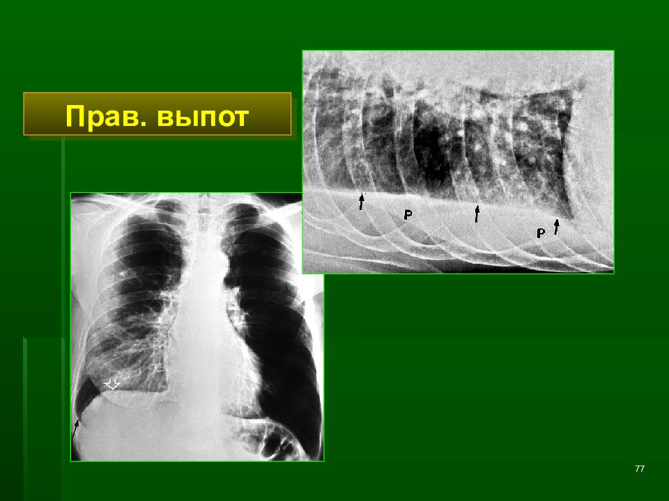 Лучевая диагностика хобл презентация