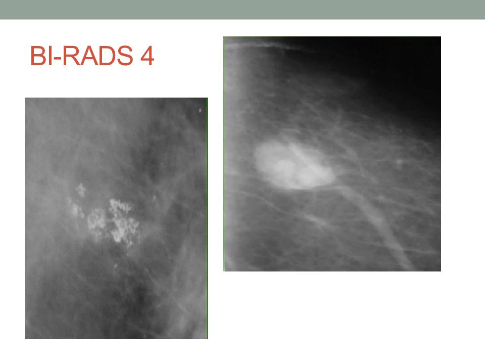 Rads 5 молочной железы что. Бирадс молочной железы. Bi-rads 3 молочной железы что это. Маммография молочных желез bi rads 1. Категория bi-rads.