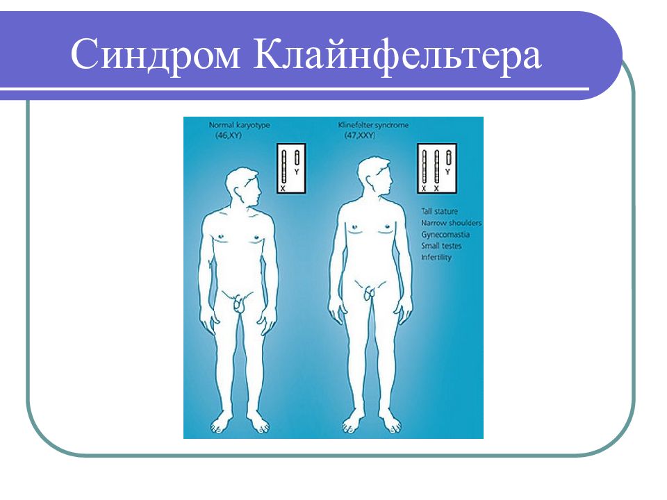 Клиническая картина синдрома клайнфельтера