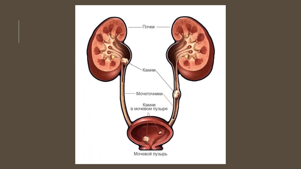 Беременность и мочекаменная болезнь презентация