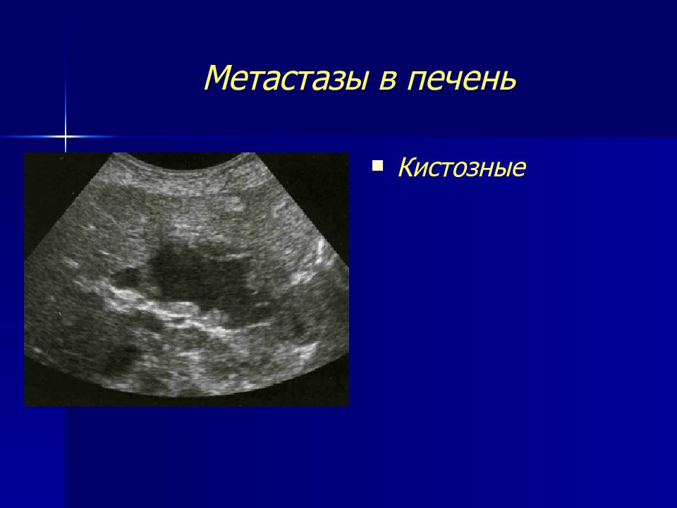 Рак метастазы в печень лечение
