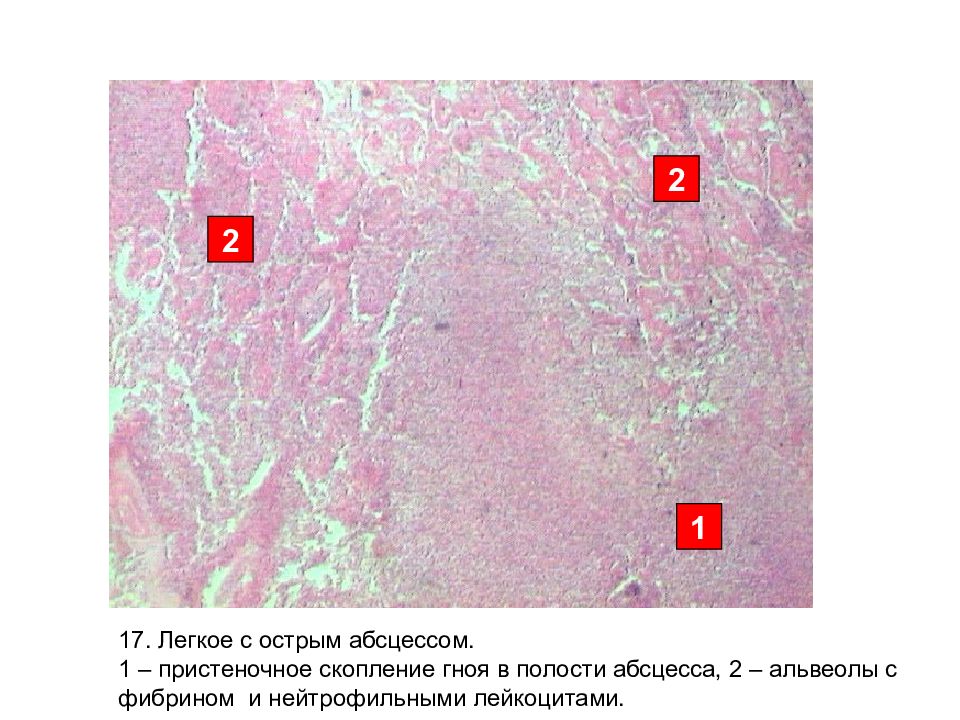 Абсцесс печени микропрепарат рисунок