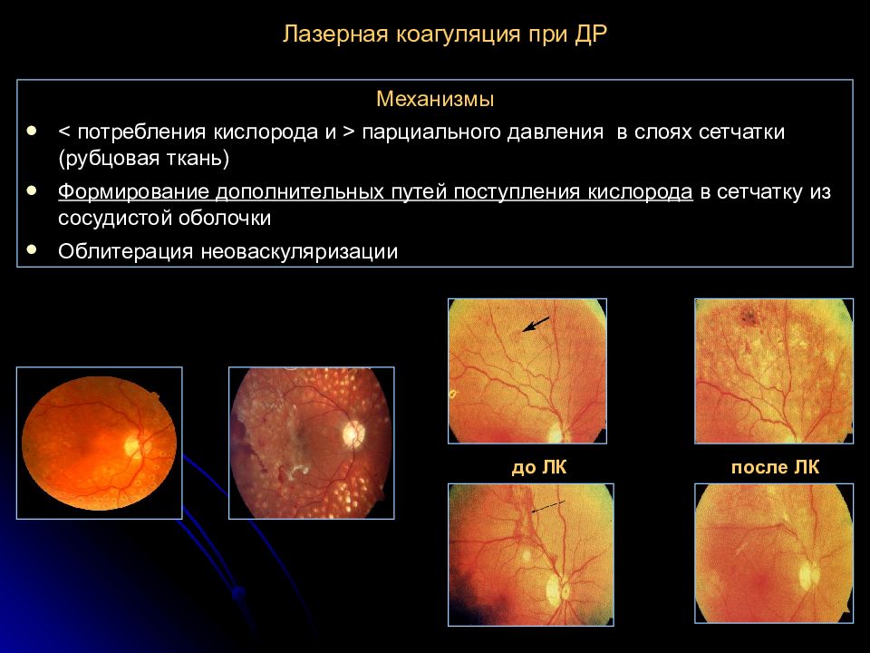 Лазерная коагуляция. Панретинальная лазеркоагуляция. Виды коагуляции. Панретинальная лазерная коагуляция.