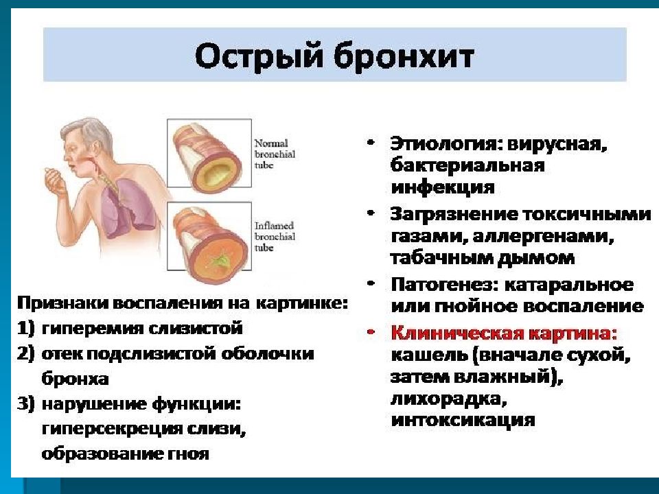 Симптомы бронхита у взрослых без температуры. Назовите основные симптомы бронхита. Острый инфекционный бронхит. Признаки острого бронхита. Бронхит вирусной этиологии.